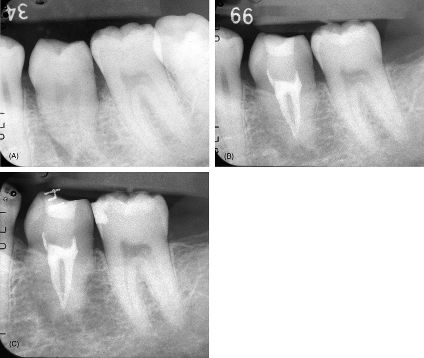 Replacement Resorption Gaylord MI, Otsego Endodontics